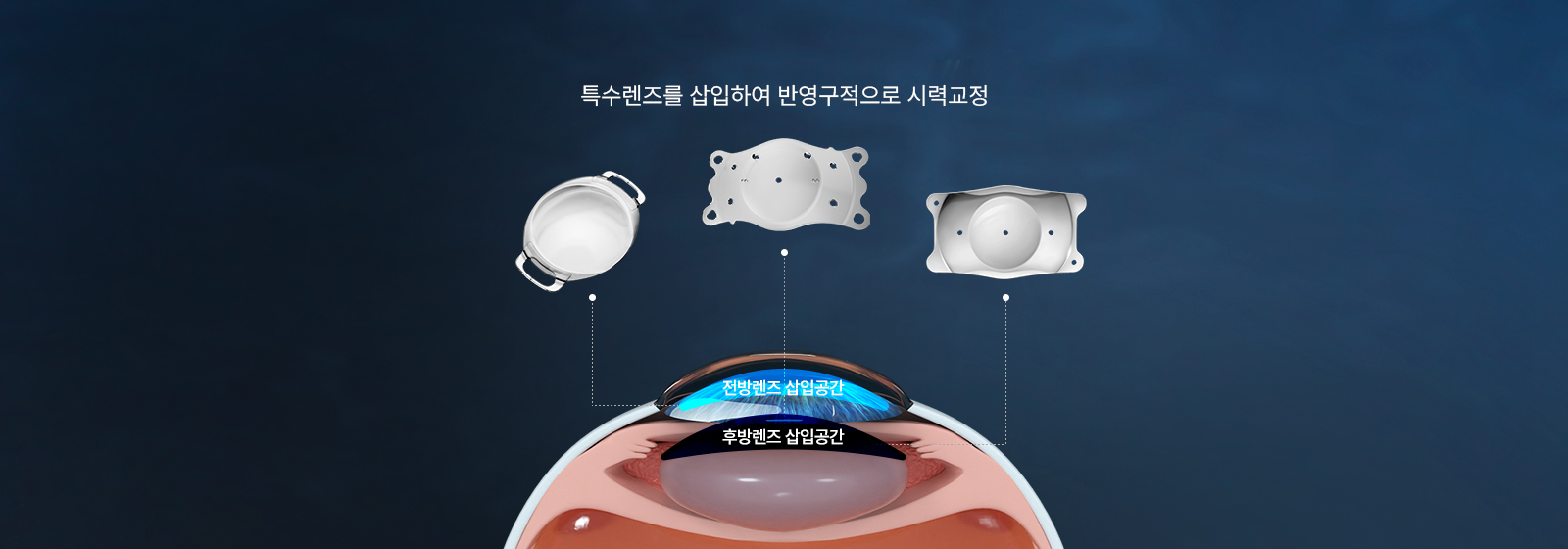 렌즈삽입술 개념 이미지