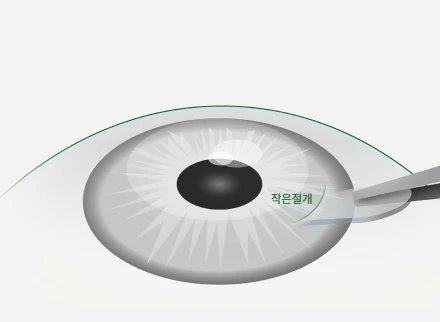 작은 절개로 렌티큘 제거